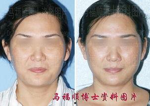 颧骨突出图片,颧骨突出矫正之美学探索